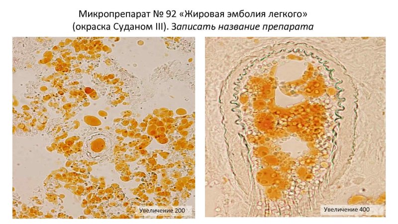 Жировая эмболия Судан 3 микропрепарат