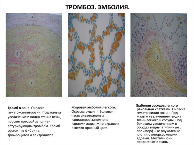 Тромбоз вены микропрепарат