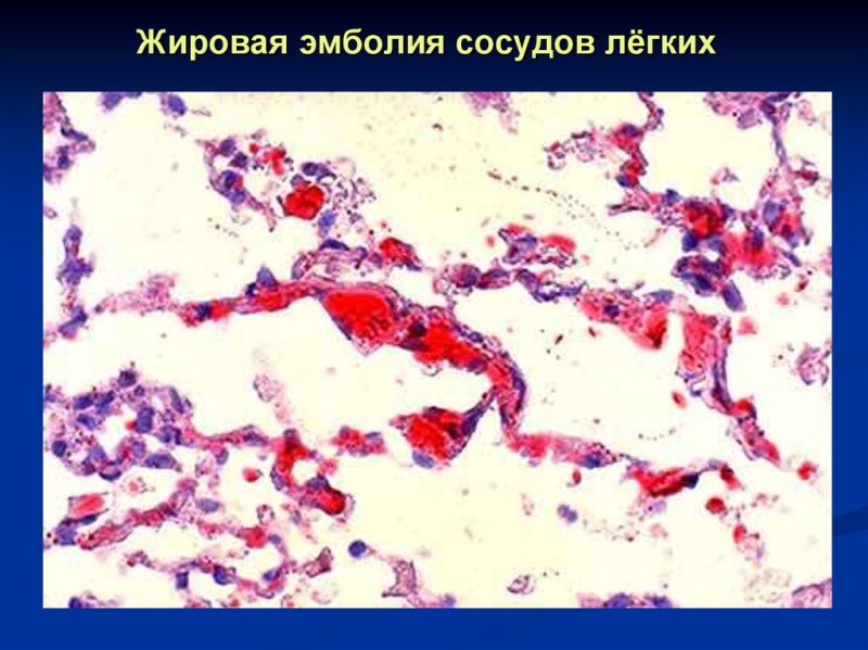 Жировая эмболия сосудов легкого микропрепарат