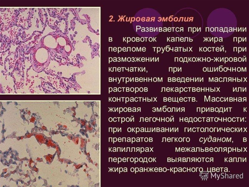 Жировая эмболия сосудов легкого микропрепарат