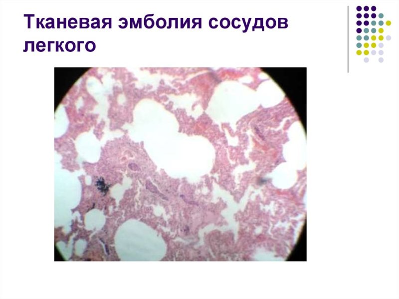 Тканевая эмболия сосудов легкого