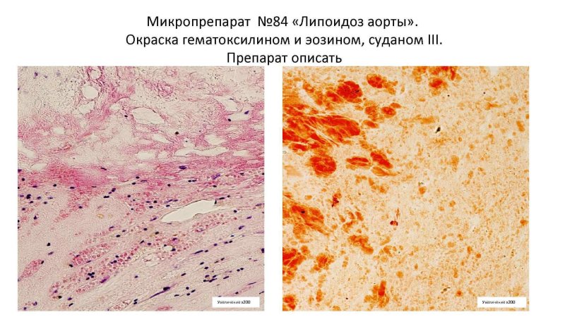 Атеросклероз коронарных сосудов микропрепарат