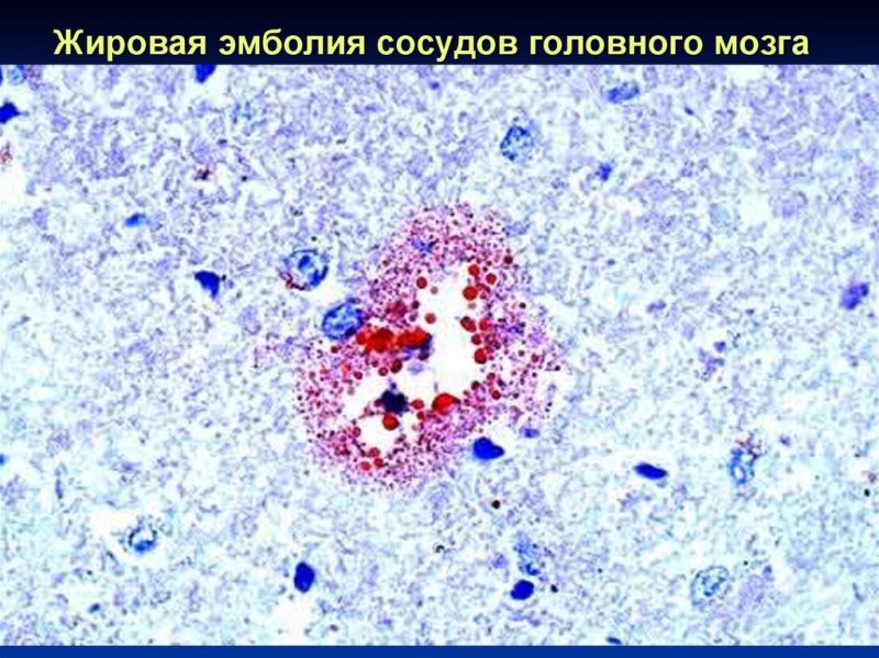 Жировая эмболия Судан 3 микропрепарат