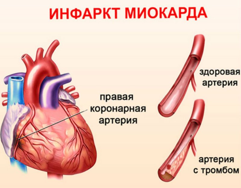 Инфаркт миокарда картинки