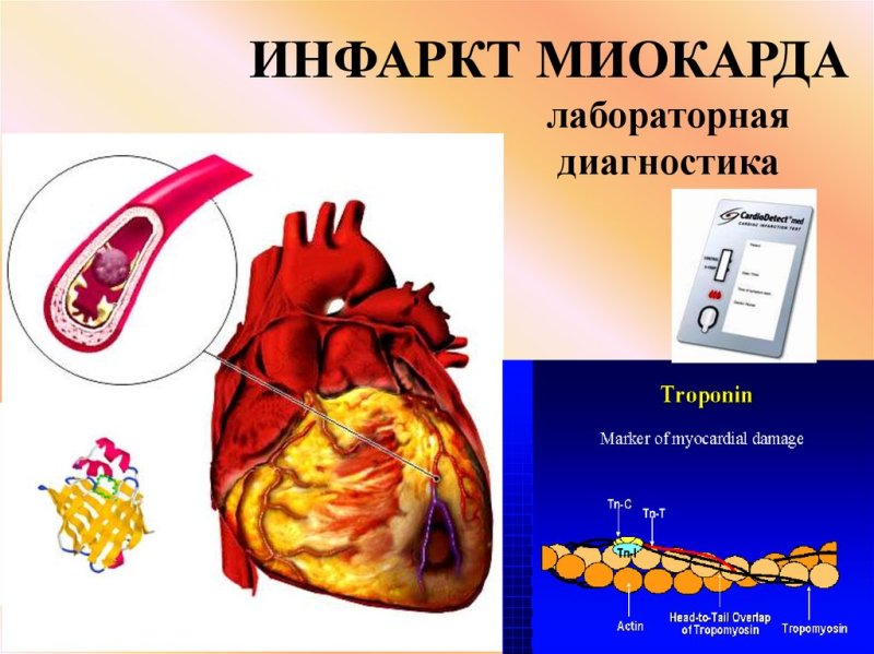 Сердце инфаркт миокарда