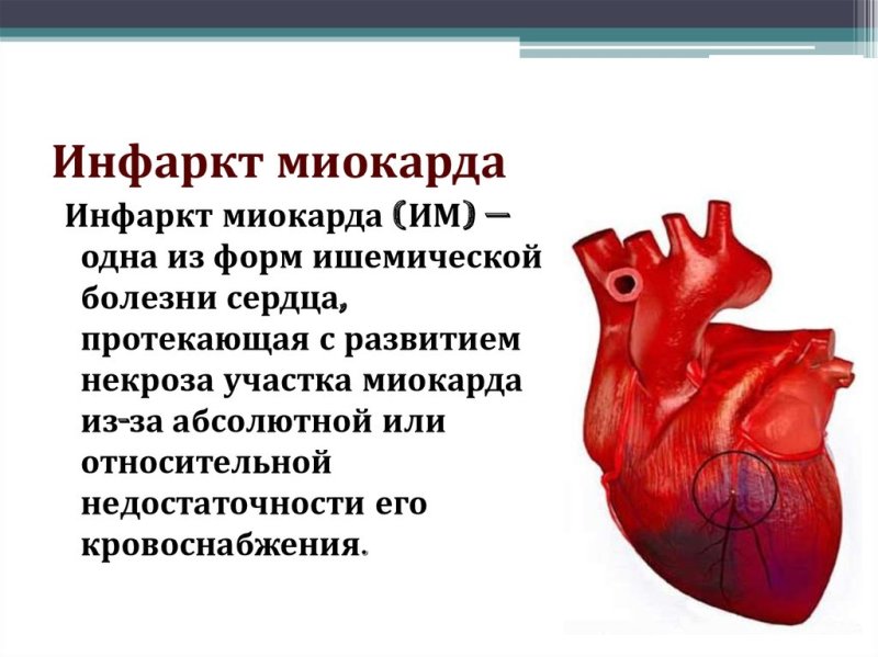 Острый инфаркт миокарда кратко