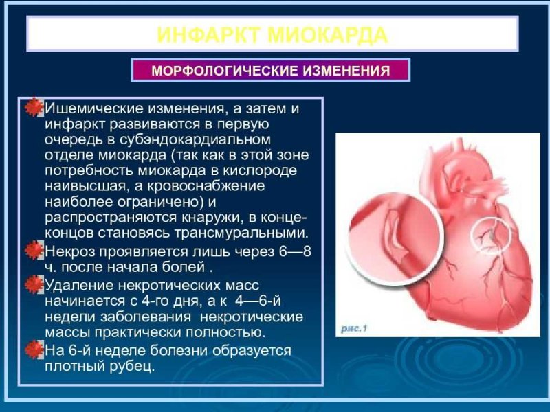 Болезни сердца инфаркт