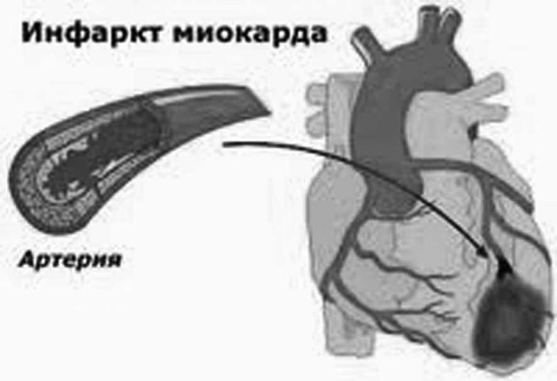 Рубец при инфаркте миокарда