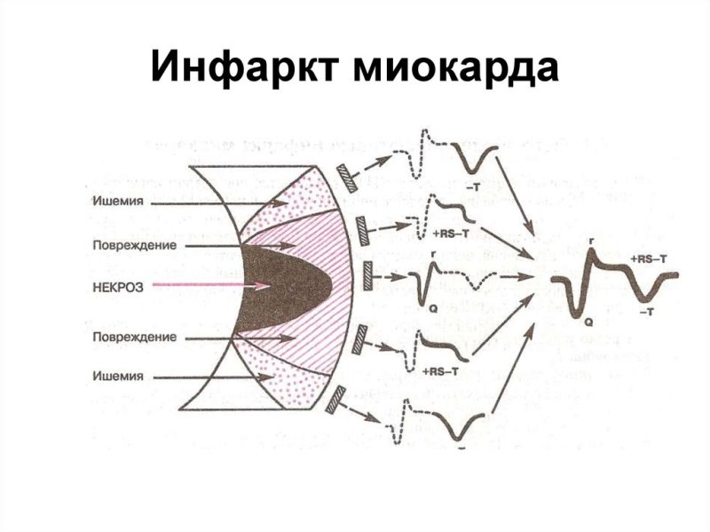 Инфаркт миокарда схема повреждения