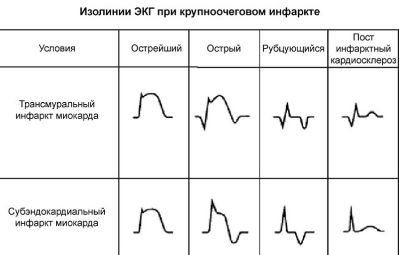 подострая стадия крупноочаговом инфаркте миокарда на экг
