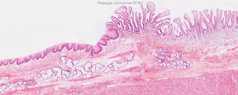 Акантоз гликогеновый пищевода гистология
