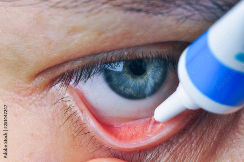 конъюнктивит мешок конъюнктивальный