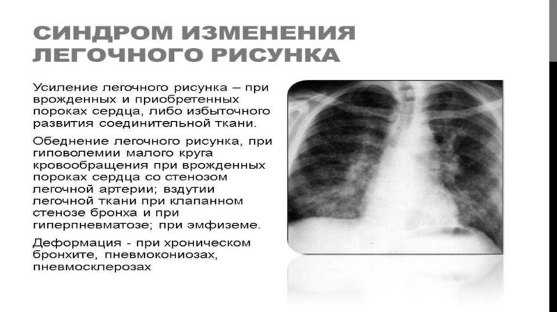 Синдром изменения легочного рисунка рентген