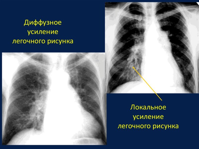 Усиление легочного рисунка