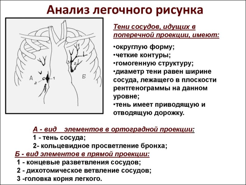 Анализ легочного рисунка