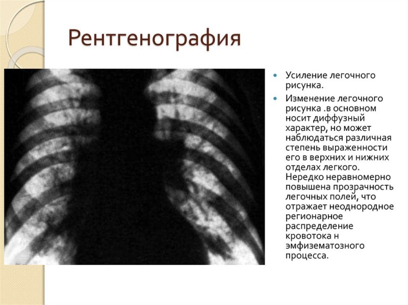 Легочный усилен