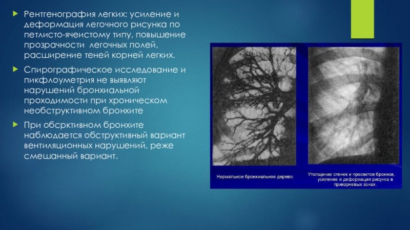 Легочный рисунок усилен в прикорневых зонах