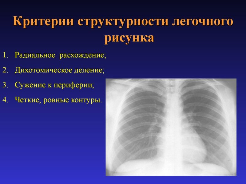 Легочный рисунок