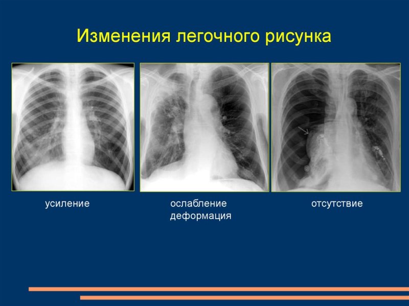 Легочный рисунок ослаблен