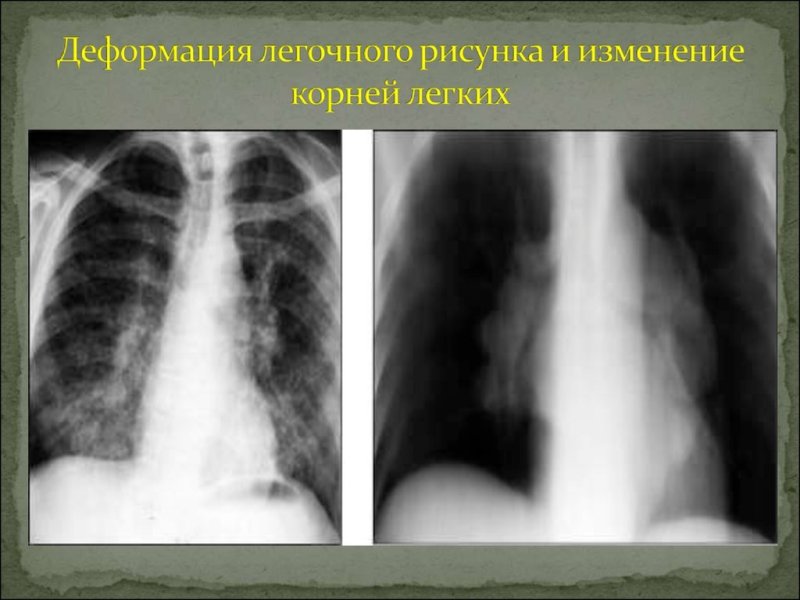 Деформация легочного рисунка на рентгене