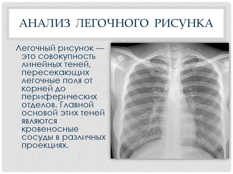 Усиленный легочный рисунок на рентгене что это