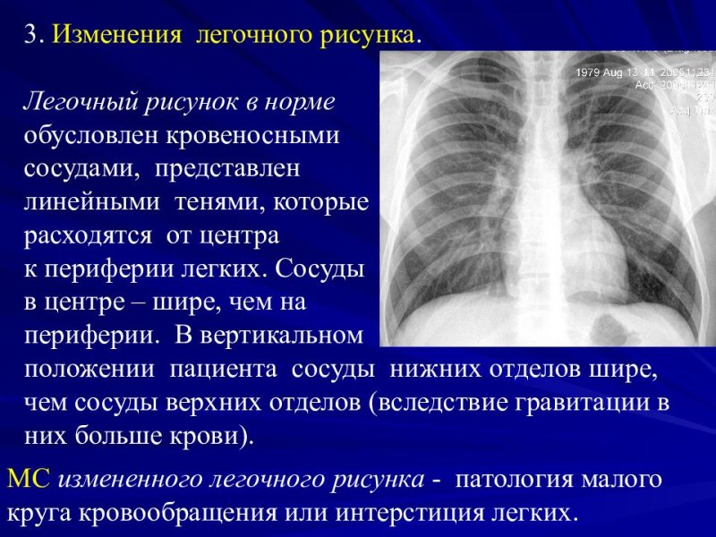 Легочный рисунок деформирован