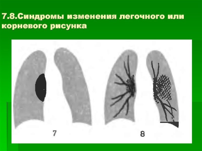 Изменение легочного рисунка