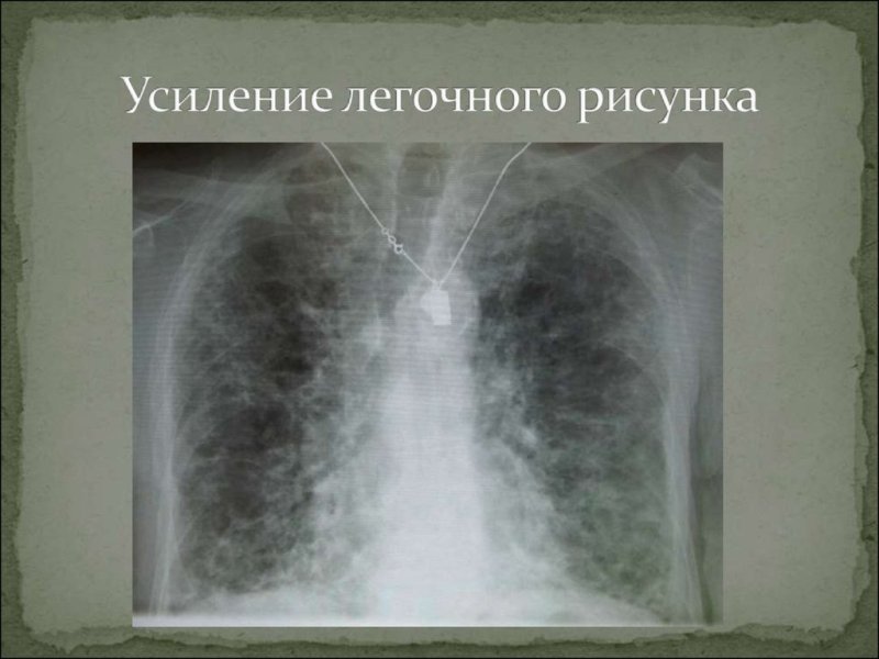Усиление легочного рисунка