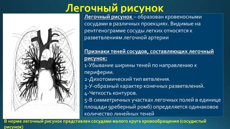 Легочный рисунок в норме