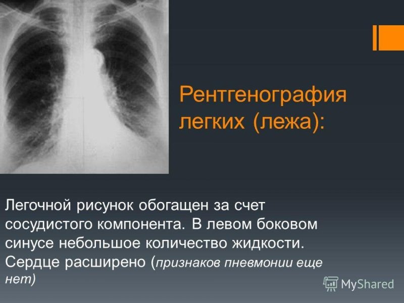 Усиление сосудистого рисунка легких