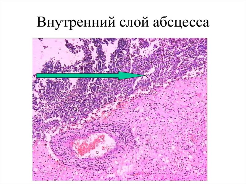 Хронический абсцесс гистология