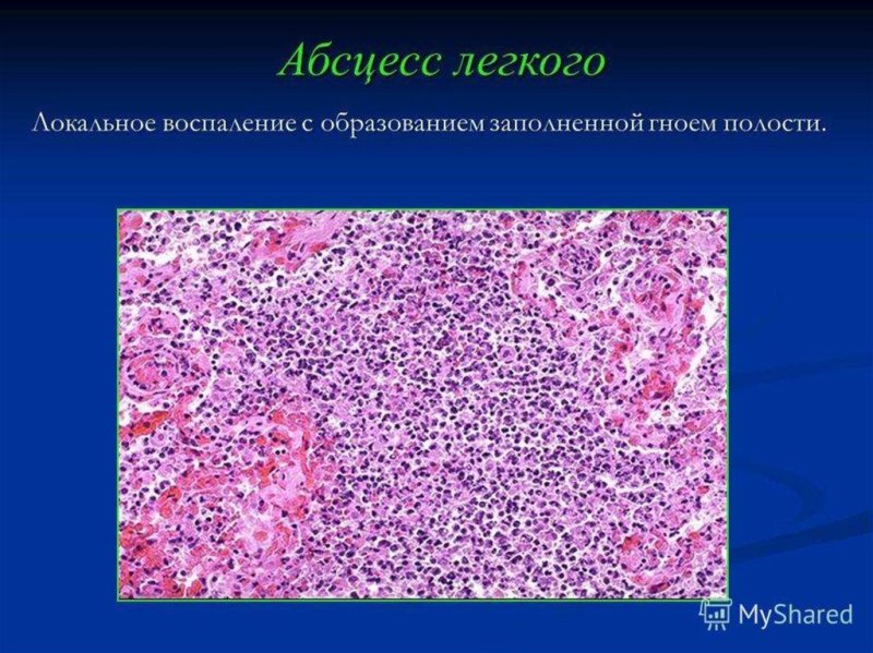 Абсцедирующая пневмония микропрепарат рисунок