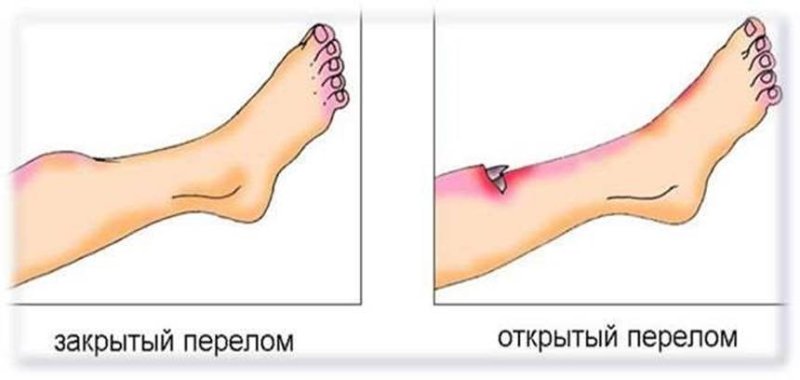 Открытый и закрытый перелом рисунок