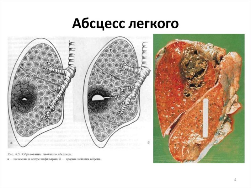 Актиномикотические абсцессы в печени макропрепарат