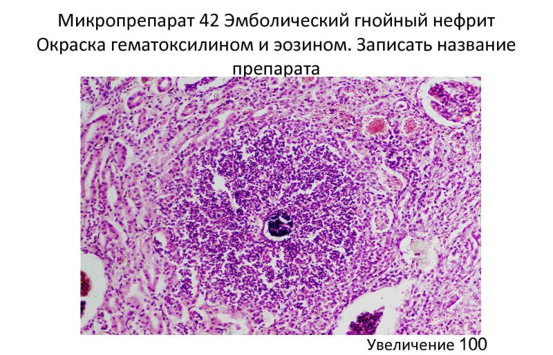 Эмболический Гнойный нефрит