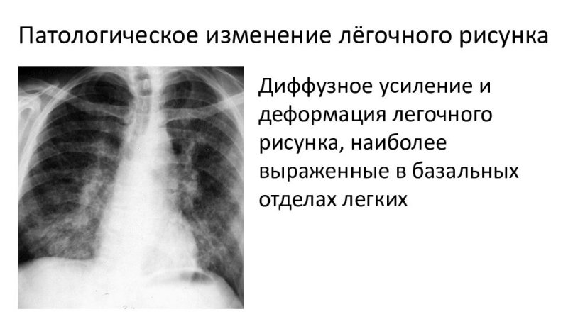 Диффузное усиление легочного рисунка что это такое