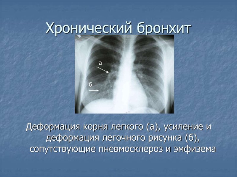 Рентген хр бронхита