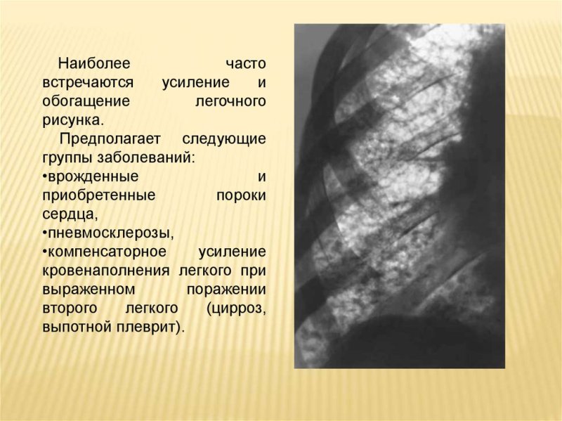 Легочный рисунок