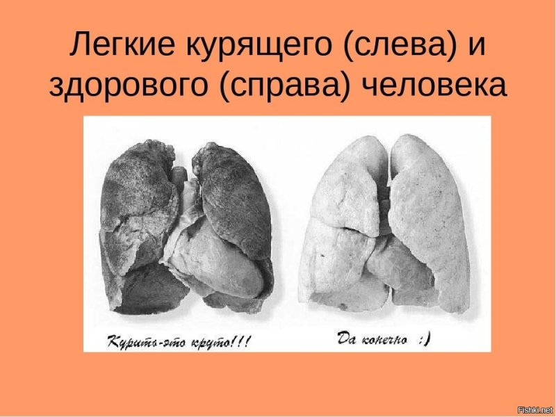 Легкие курящего человека рентген