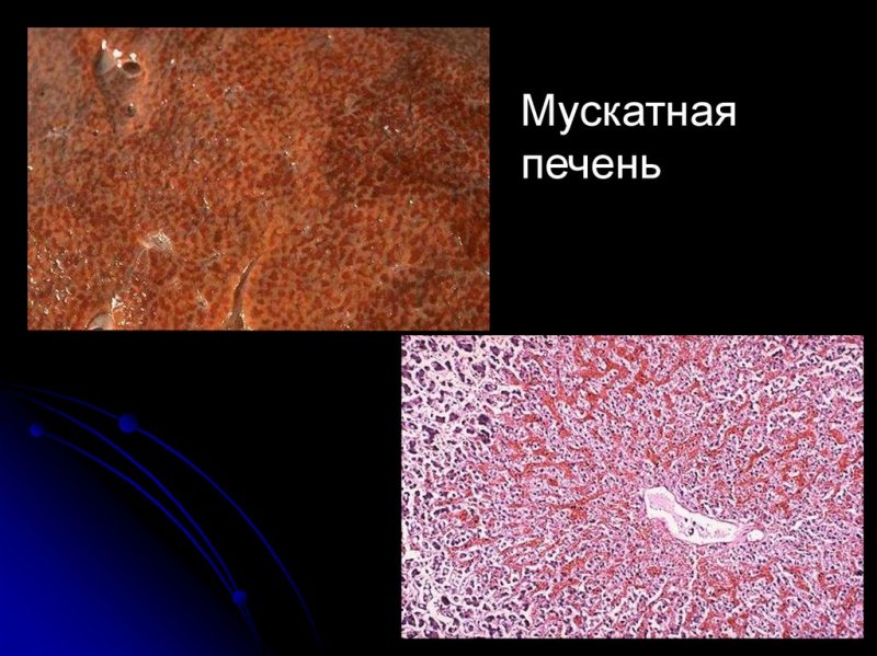 Венозное полнокровие печени мускатная печень