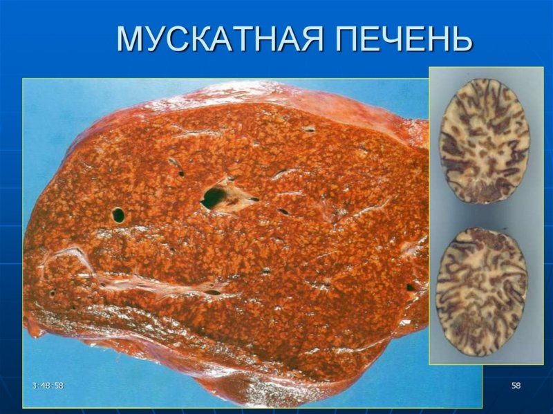 Мускатная печень патологическая анатомия