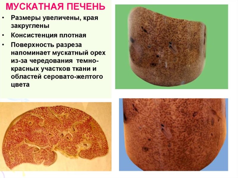 Мускатный цирроз печени макропрепарат