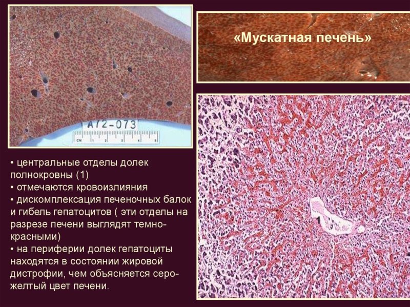 Мускатная печень патанатомия этиология