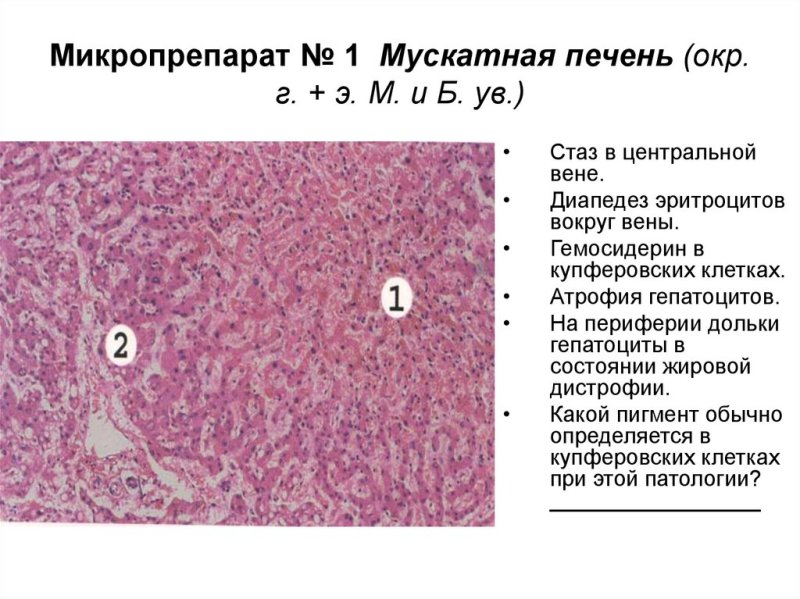 Мускатная печень гистология