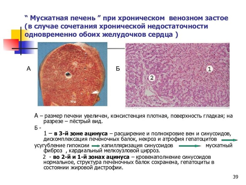 Венозное полнокровие печени мускатная печень