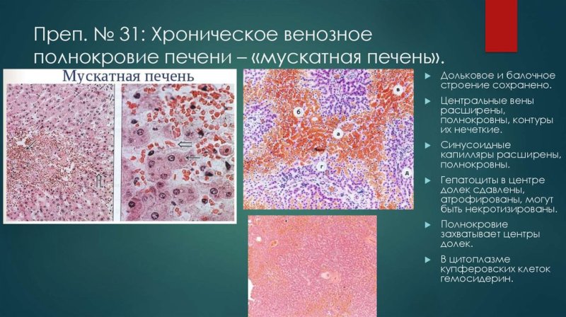 Венозное полнокровие печени микропрепарат