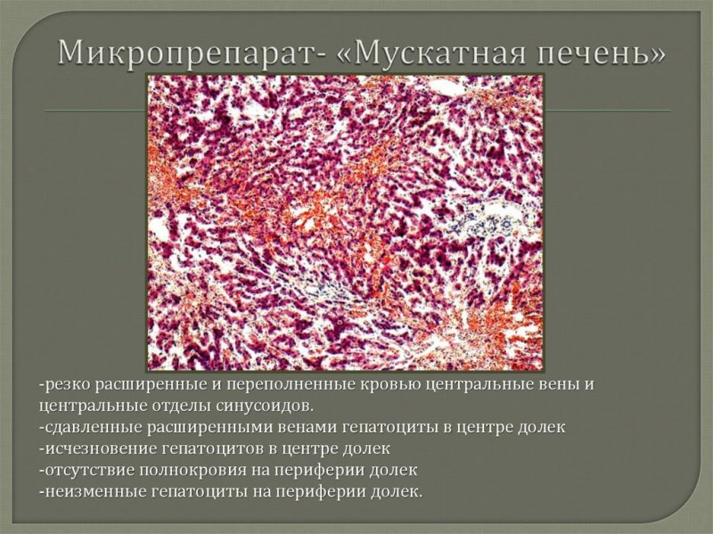 Венозное полнокровие печени микропрепарат