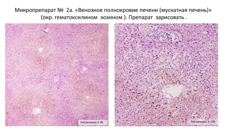 Мускатный цирроз печени микропрепарат
