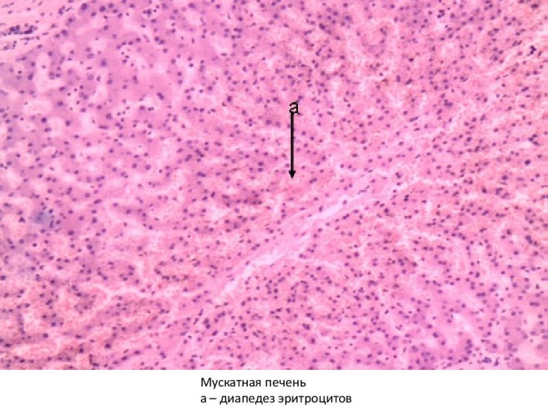 Мускатная печень микропрепарат