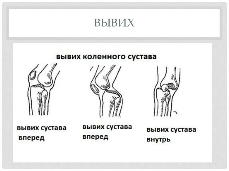 Строение сустава с вывихом